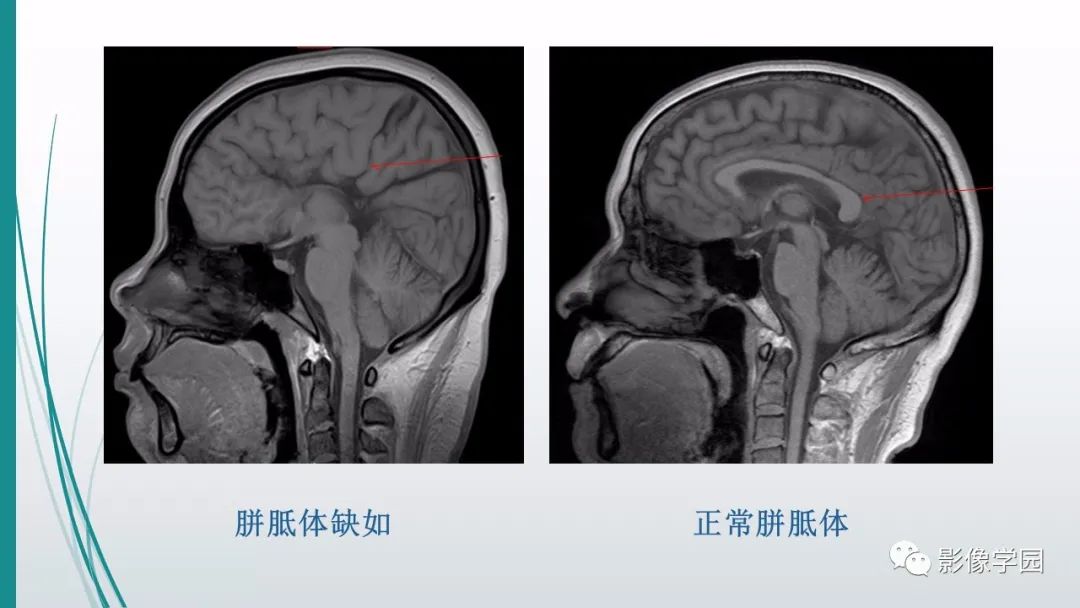 影像PPT - 【PPT】颅脑先天性畸形及发育异常的影像诊断-23