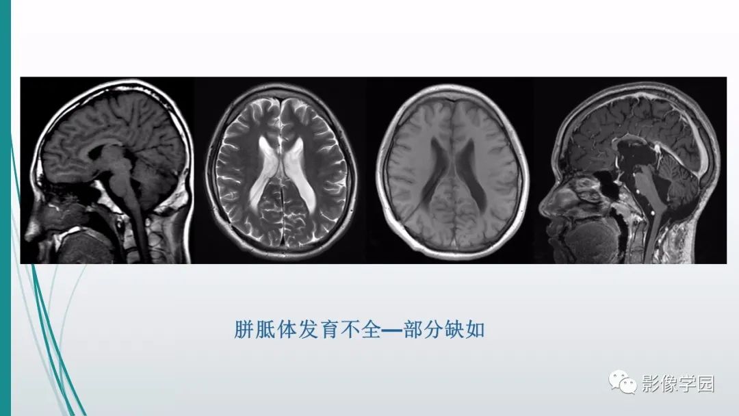 影像PPT - 【PPT】颅脑先天性畸形及发育异常的影像诊断-24