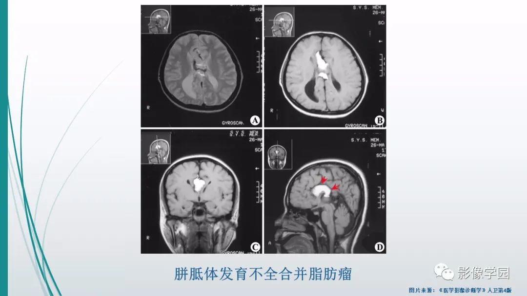 影像PPT - 【PPT】颅脑先天性畸形及发育异常的影像诊断-25