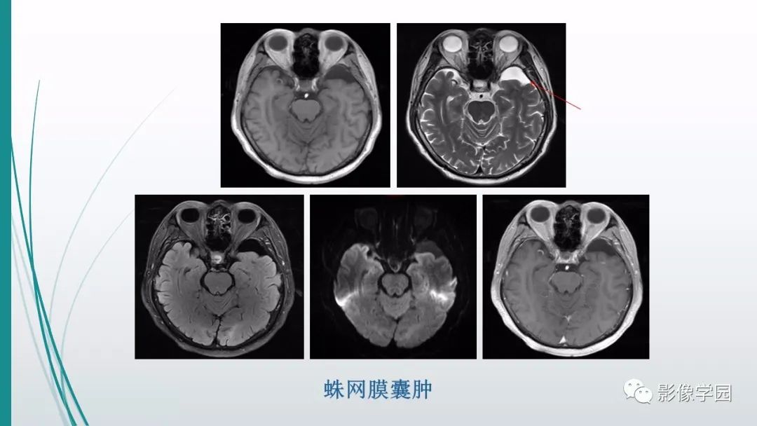 影像PPT - 【PPT】颅脑先天性畸形及发育异常的影像诊断-28