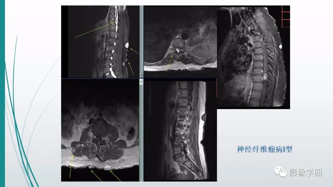 影像PPT - 【PPT】颅脑先天性畸形及发育异常的影像诊断-34