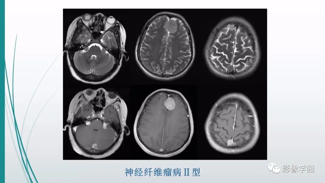 影像PPT - 【PPT】颅脑先天性畸形及发育异常的影像诊断-36