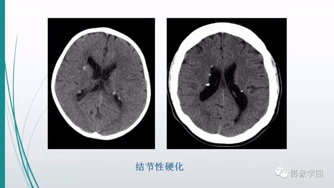 影像PPT - 【PPT】颅脑先天性畸形及发育异常的影像诊断-40