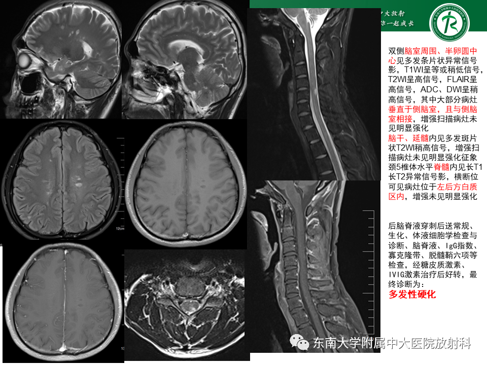 影像PPT - 【PPT】多发性硬化-2 影像PPT - 【PPT】多发性硬化-2