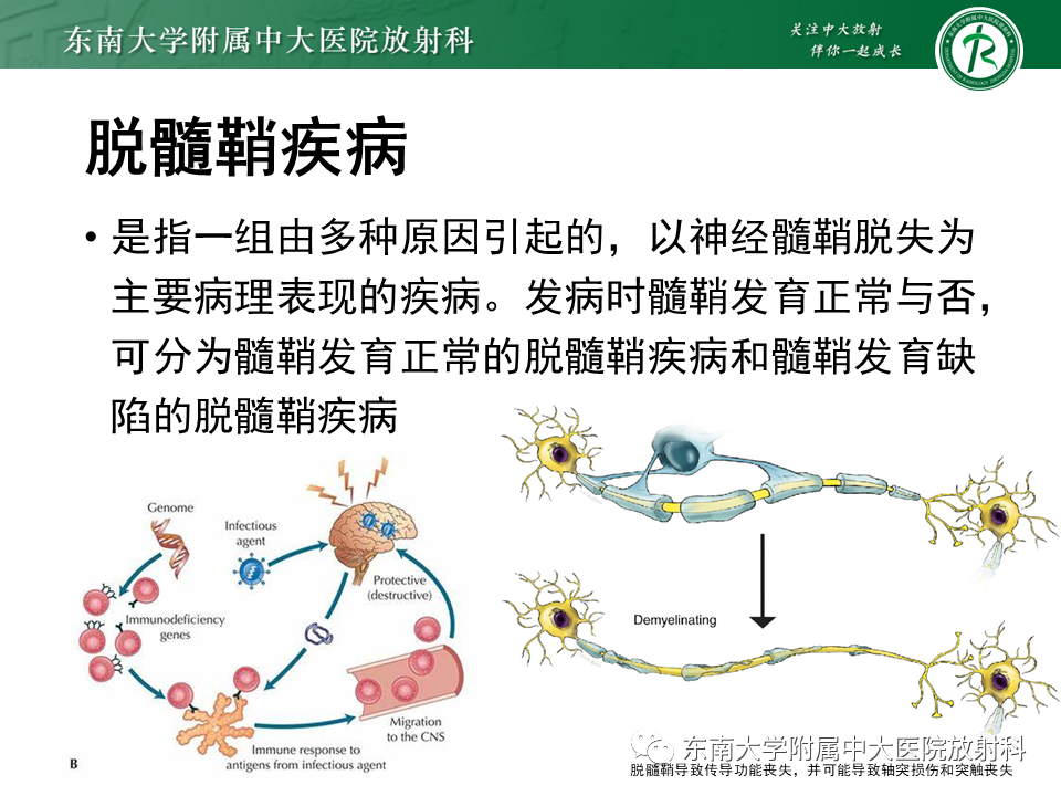 影像PPT - 【PPT】多发性硬化-4 影像PPT - 【PPT】多发性硬化-4