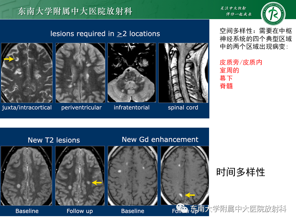 影像PPT - 【PPT】多发性硬化-13 影像PPT - 【PPT】多发性硬化-13