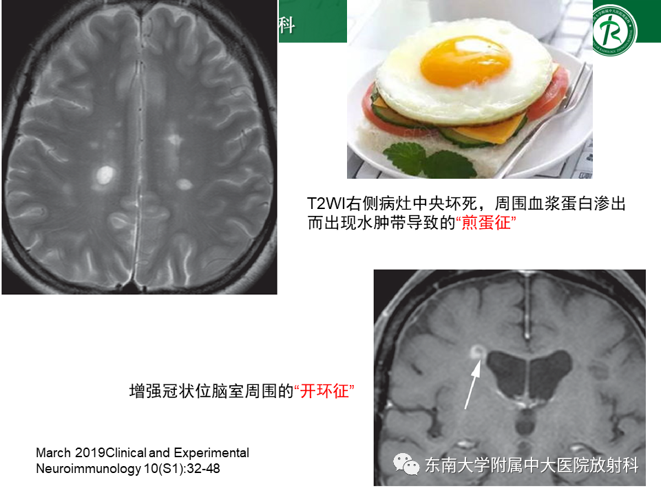 影像PPT - 【PPT】多发性硬化-19 影像PPT - 【PPT】多发性硬化-19