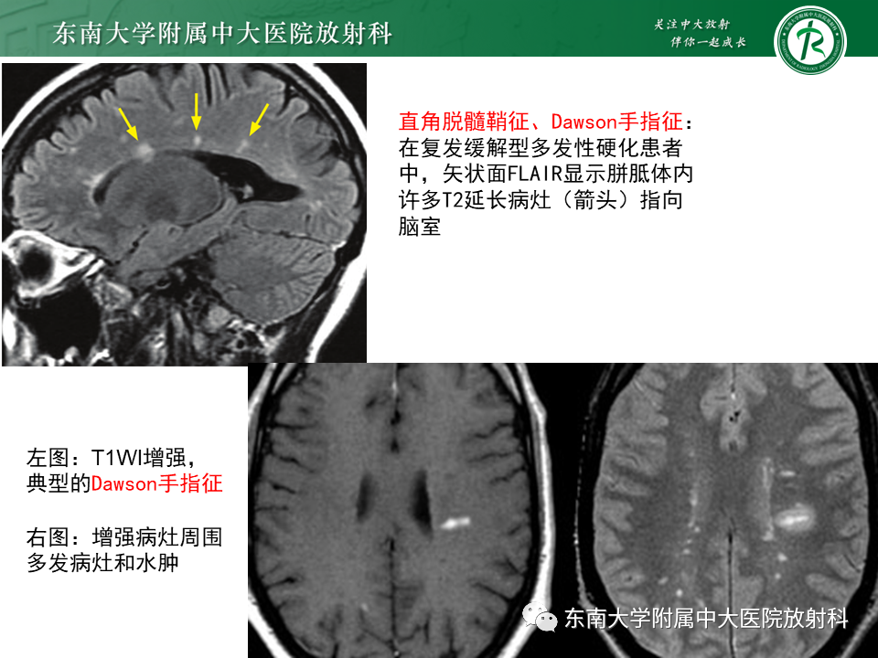 影像PPT - 【PPT】多发性硬化-18 影像PPT - 【PPT】多发性硬化-18