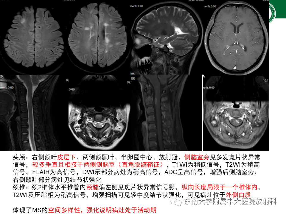 影像PPT - 【PPT】多发性硬化-21 影像PPT - 【PPT】多发性硬化-21