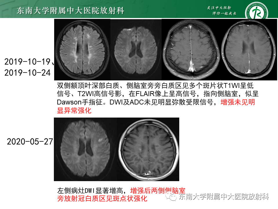 影像PPT - 【PPT】多发性硬化-23 影像PPT - 【PPT】多发性硬化-23