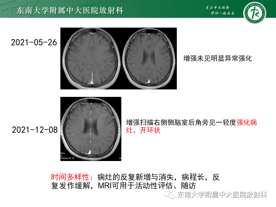 影像PPT - 【PPT】多发性硬化-24 影像PPT - 【PPT】多发性硬化-24