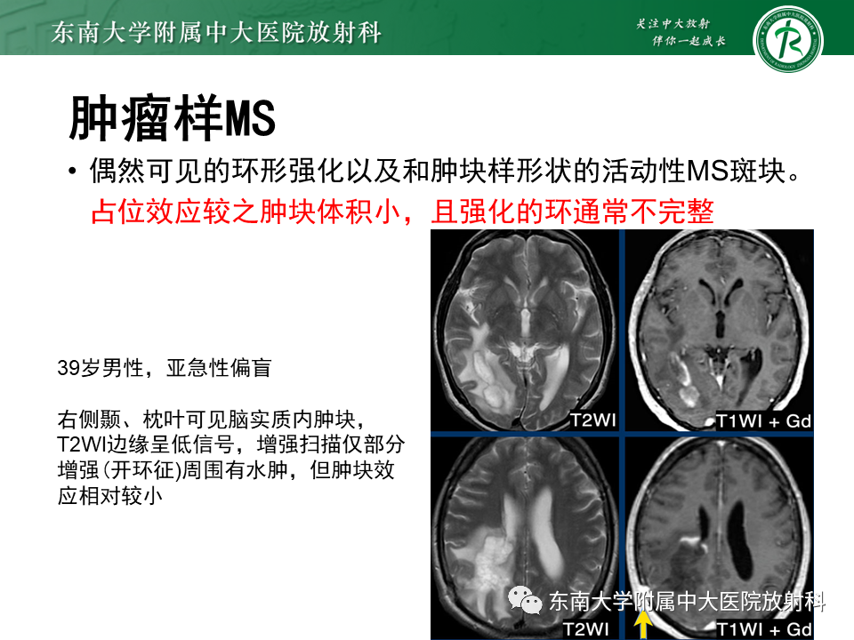 影像PPT - 【PPT】多发性硬化-26 影像PPT - 【PPT】多发性硬化-26