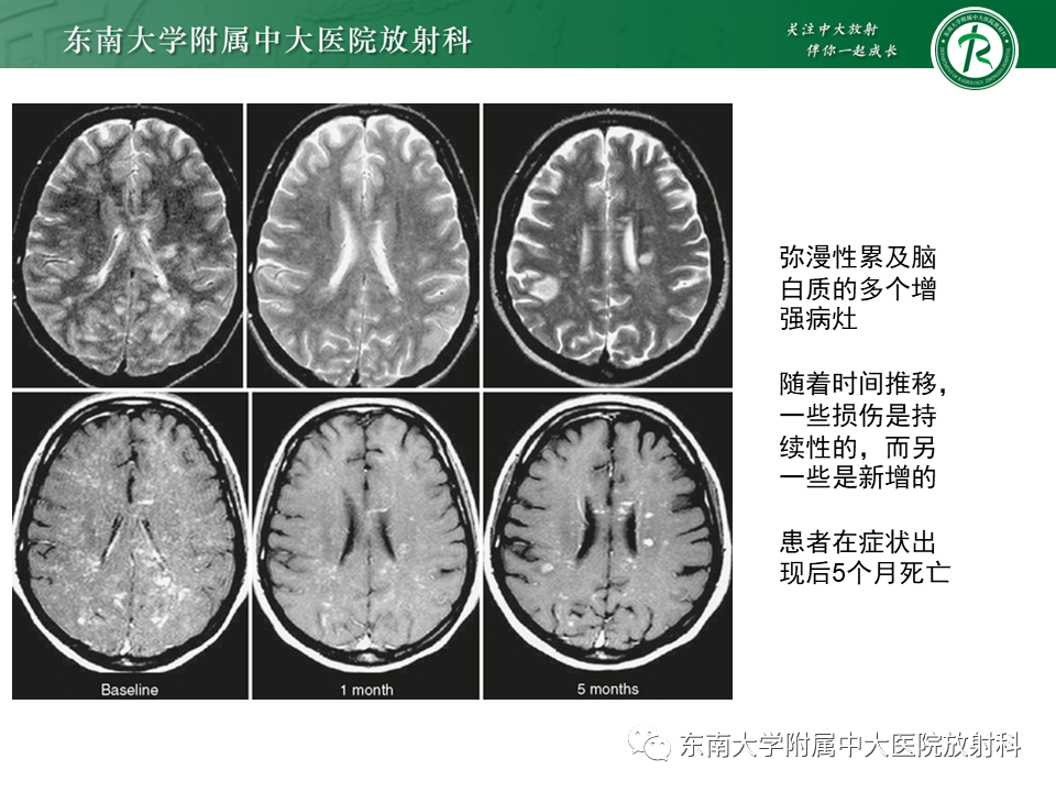 影像PPT - 【PPT】多发性硬化-28 影像PPT - 【PPT】多发性硬化-28