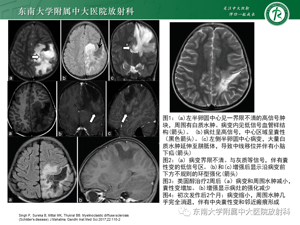 影像PPT - 【PPT】多发性硬化-30 影像PPT - 【PPT】多发性硬化-30