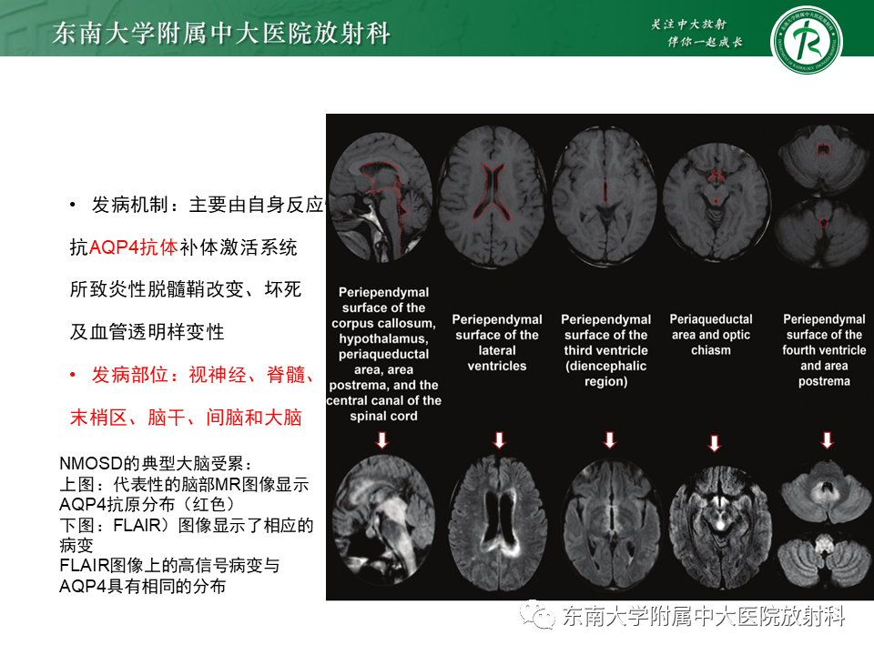 影像PPT - 【PPT】多发性硬化-34 影像PPT - 【PPT】多发性硬化-34