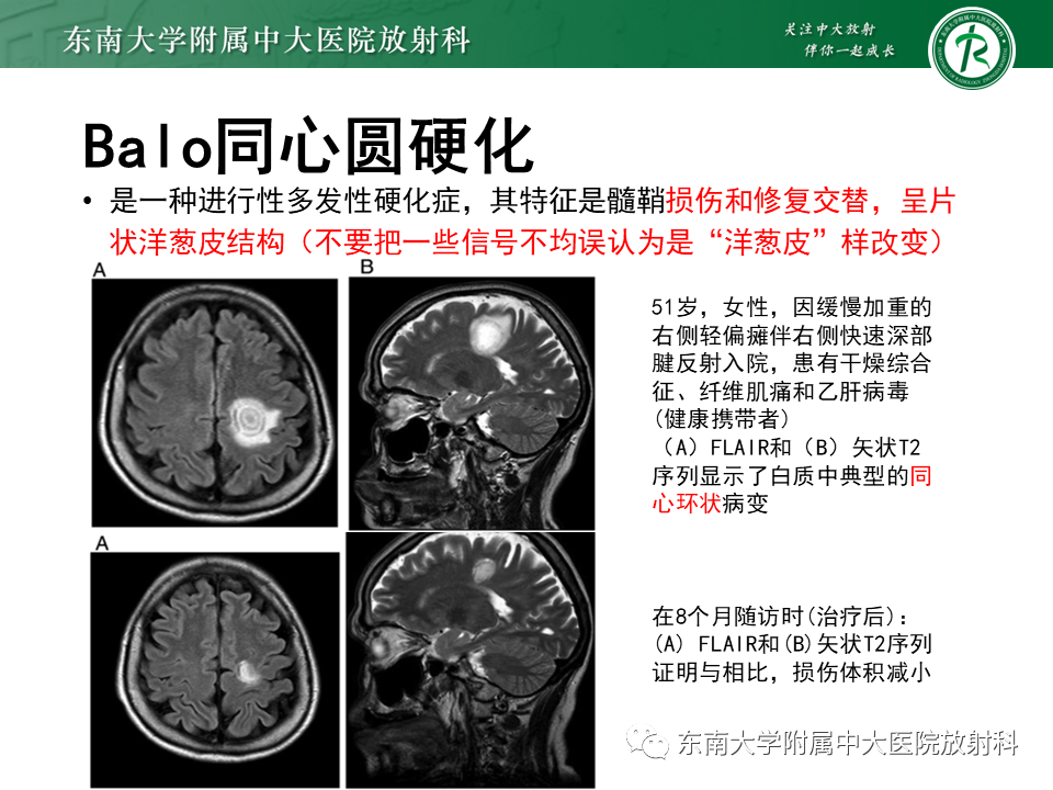 影像PPT - 【PPT】多发性硬化-31 影像PPT - 【PPT】多发性硬化-31