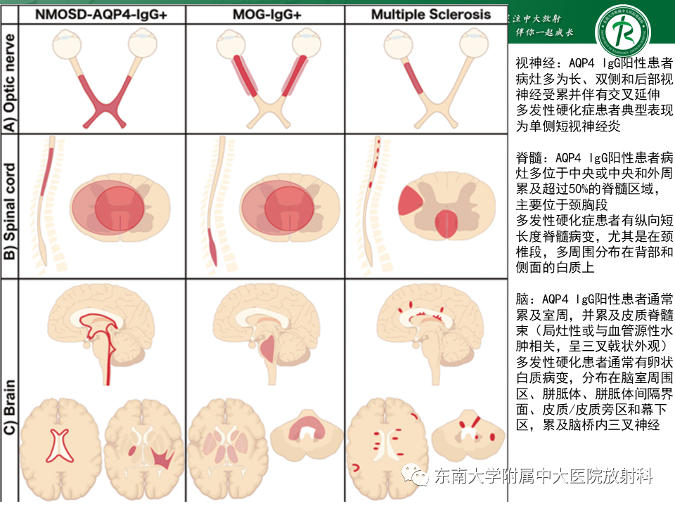 影像PPT - 【PPT】多发性硬化-39 影像PPT - 【PPT】多发性硬化-39