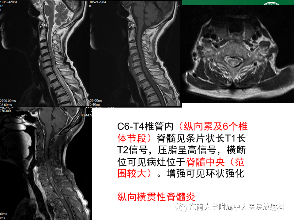 影像PPT - 【PPT】多发性硬化-38 影像PPT - 【PPT】多发性硬化-38