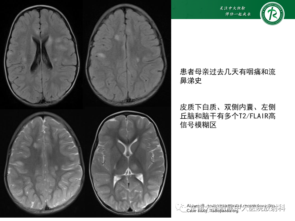 影像PPT - 【PPT】多发性硬化-42 影像PPT - 【PPT】多发性硬化-42