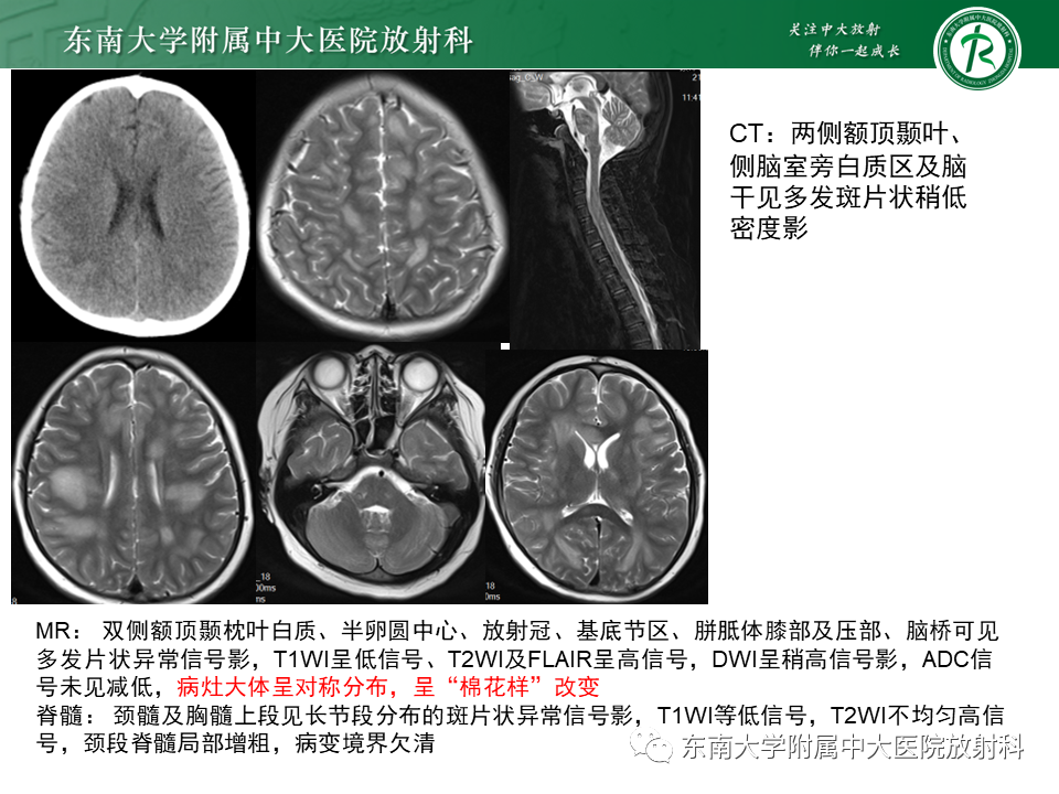 影像PPT - 【PPT】多发性硬化-44 影像PPT - 【PPT】多发性硬化-44