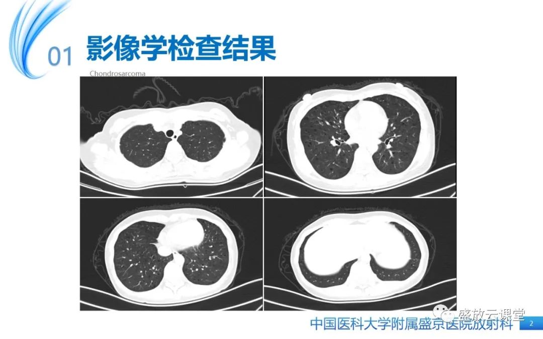影像PPT - 【PPT】肺淋巴管肌瘤病-2