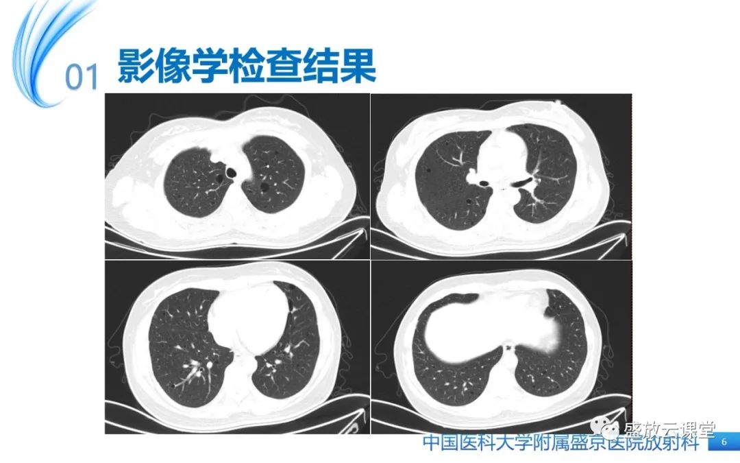 影像PPT - 【PPT】肺淋巴管肌瘤病-6