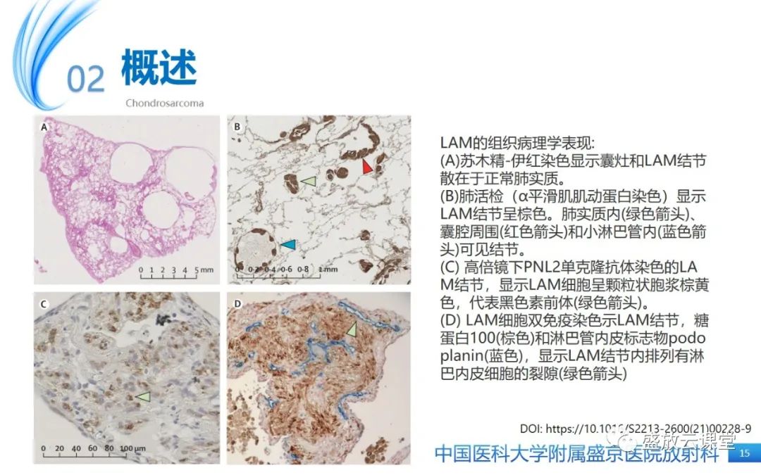 影像PPT - 【PPT】肺淋巴管肌瘤病-14