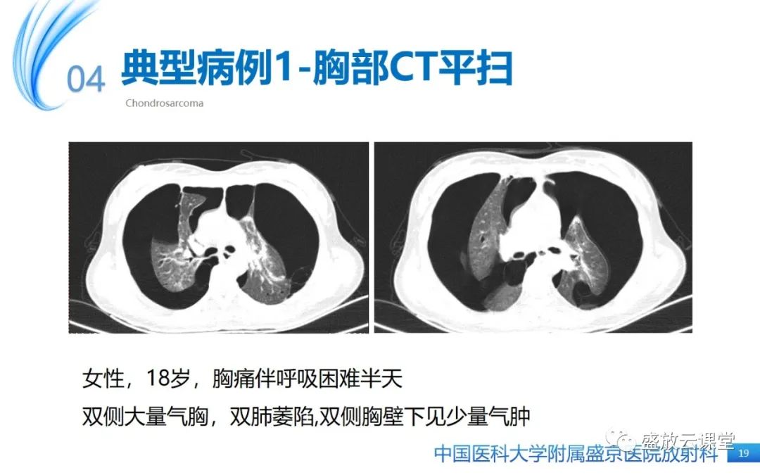 影像PPT - 【PPT】肺淋巴管肌瘤病-18