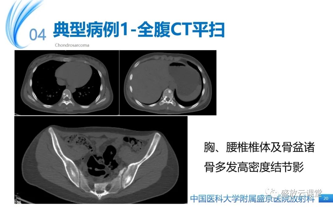 影像PPT - 【PPT】肺淋巴管肌瘤病-19