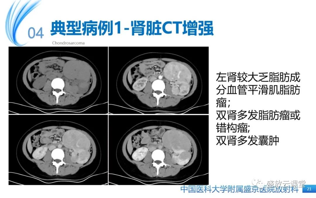 影像PPT - 【PPT】肺淋巴管肌瘤病-20