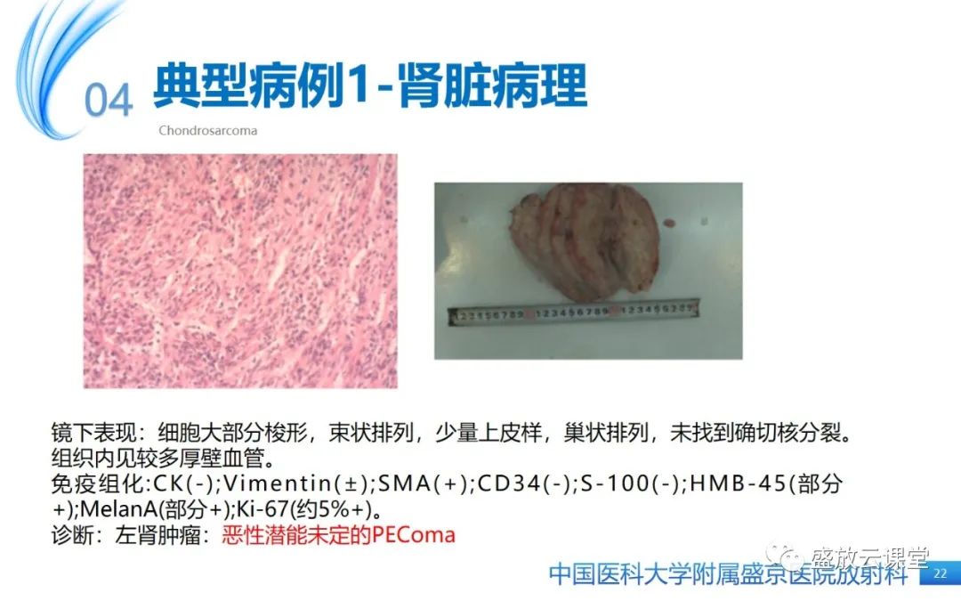 影像PPT - 【PPT】肺淋巴管肌瘤病-21