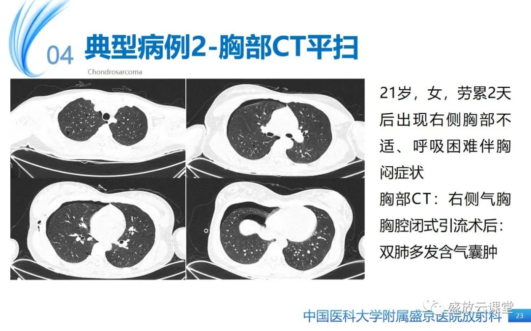影像PPT - 【PPT】肺淋巴管肌瘤病-22