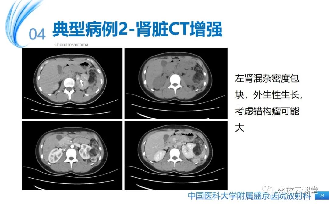 影像PPT - 【PPT】肺淋巴管肌瘤病-23