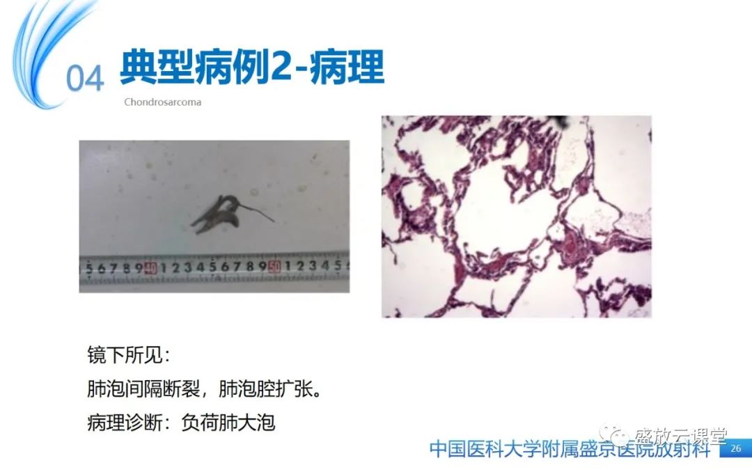影像PPT - 【PPT】肺淋巴管肌瘤病-25