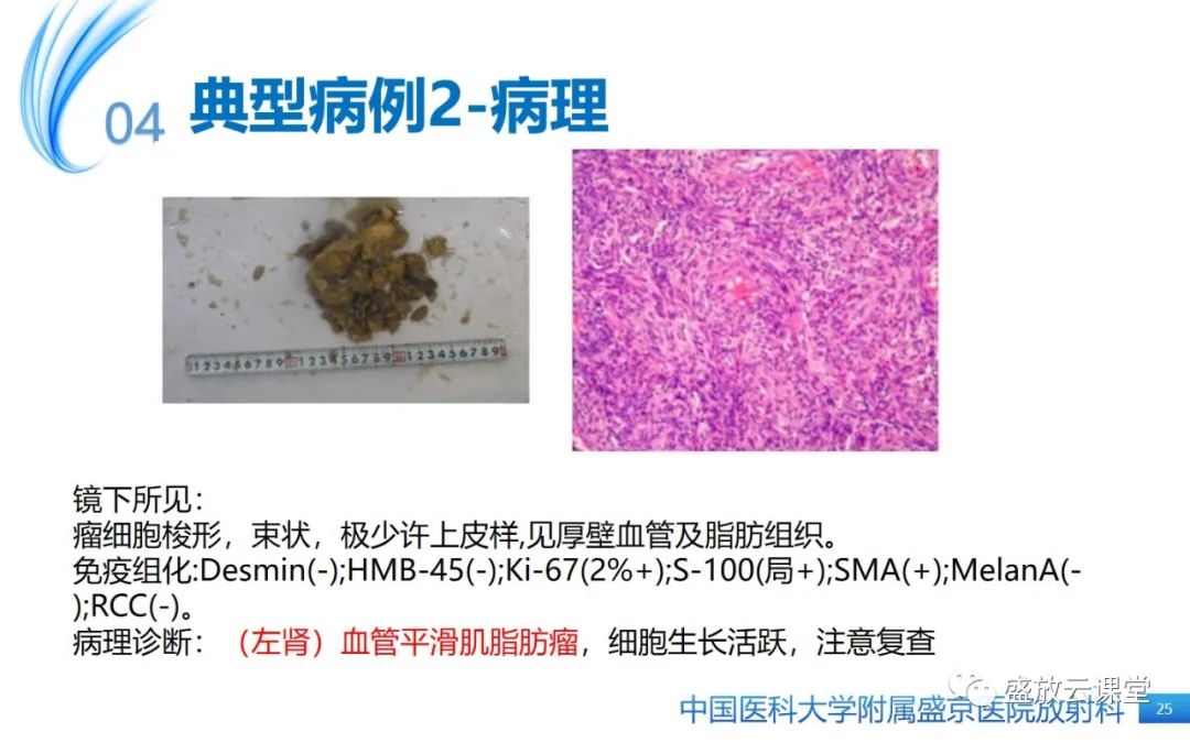 影像PPT - 【PPT】肺淋巴管肌瘤病-24