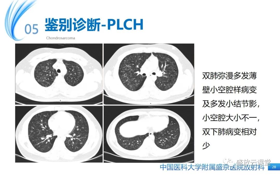 影像PPT - 【PPT】肺淋巴管肌瘤病-27