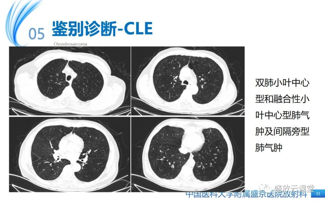 影像PPT - 【PPT】肺淋巴管肌瘤病-30