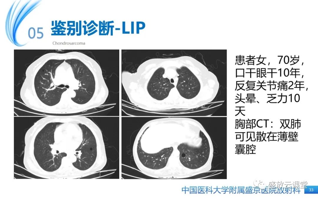 影像PPT - 【PPT】肺淋巴管肌瘤病-32
