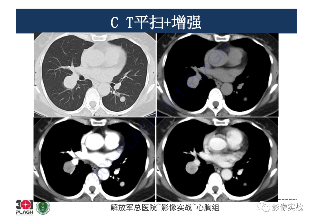 影像PPT - 【病例】硬化性肺细胞瘤1例CT影像-5