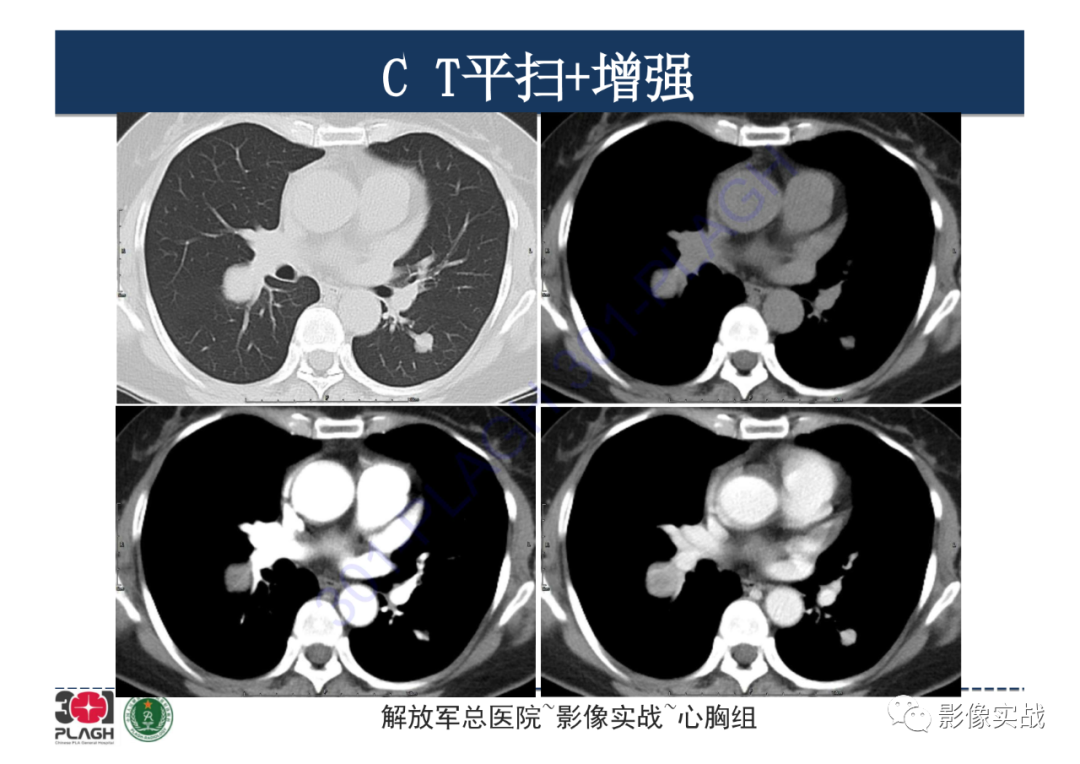 影像PPT - 【病例】硬化性肺细胞瘤1例CT影像-4