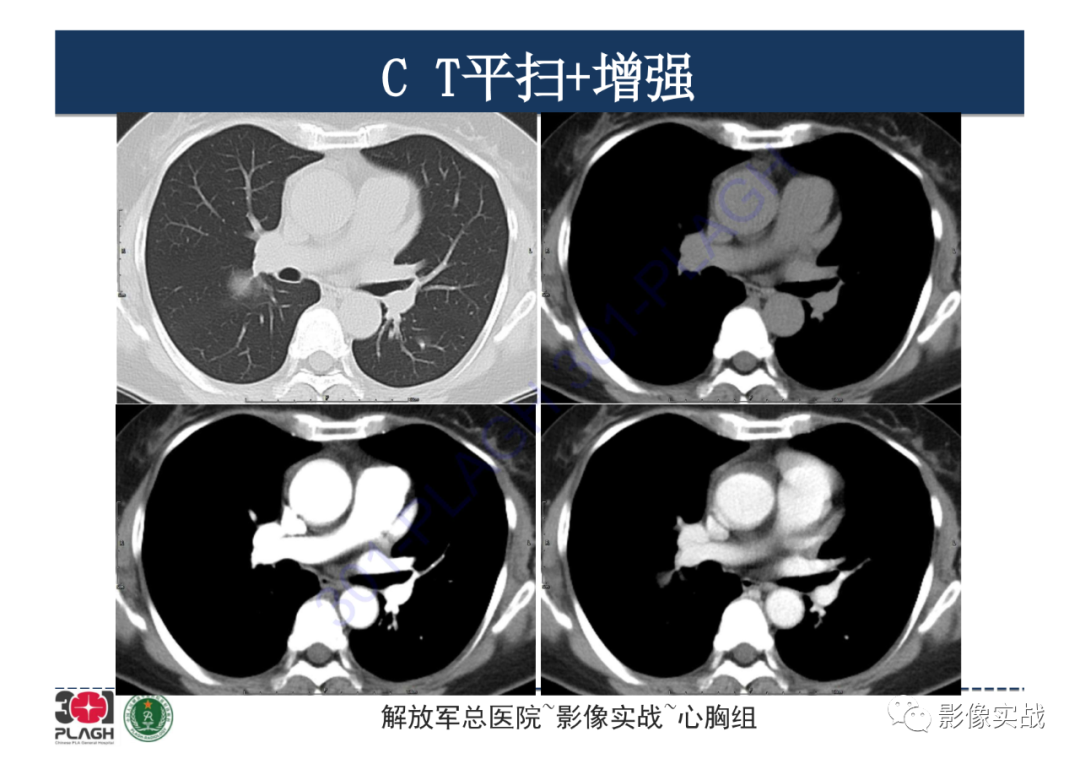 影像PPT - 【病例】硬化性肺细胞瘤1例CT影像-3