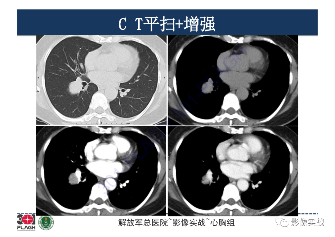 影像PPT - 【病例】硬化性肺细胞瘤1例CT影像-7