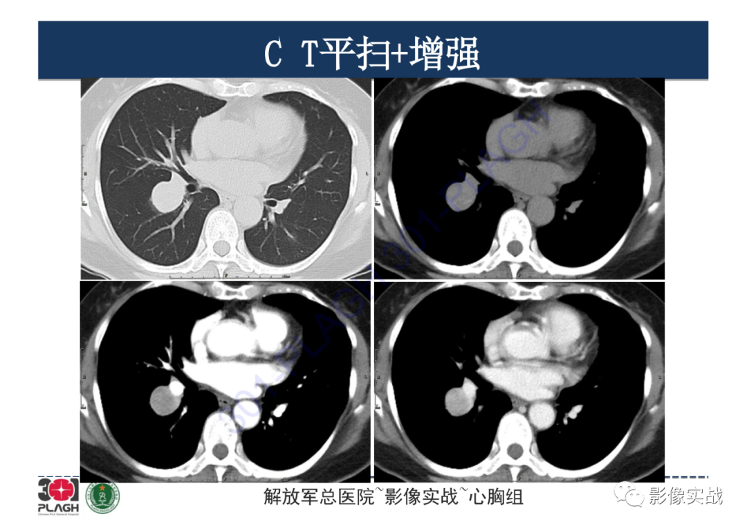 影像PPT - 【病例】硬化性肺细胞瘤1例CT影像-6
