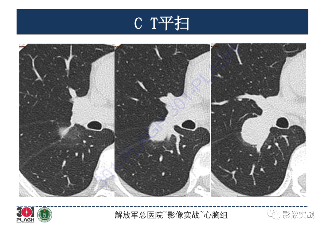 影像PPT - 【病例】硬化性肺细胞瘤1例CT影像-9