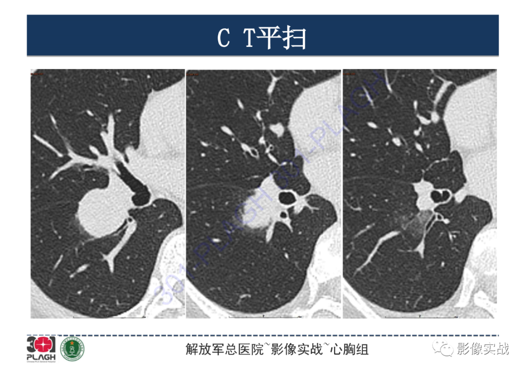影像PPT - 【病例】硬化性肺细胞瘤1例CT影像-10