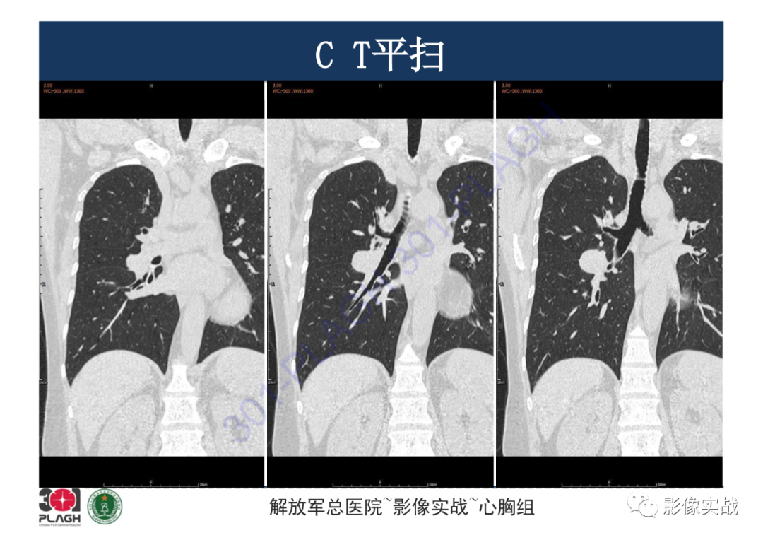 影像PPT - 【病例】硬化性肺细胞瘤1例CT影像-11