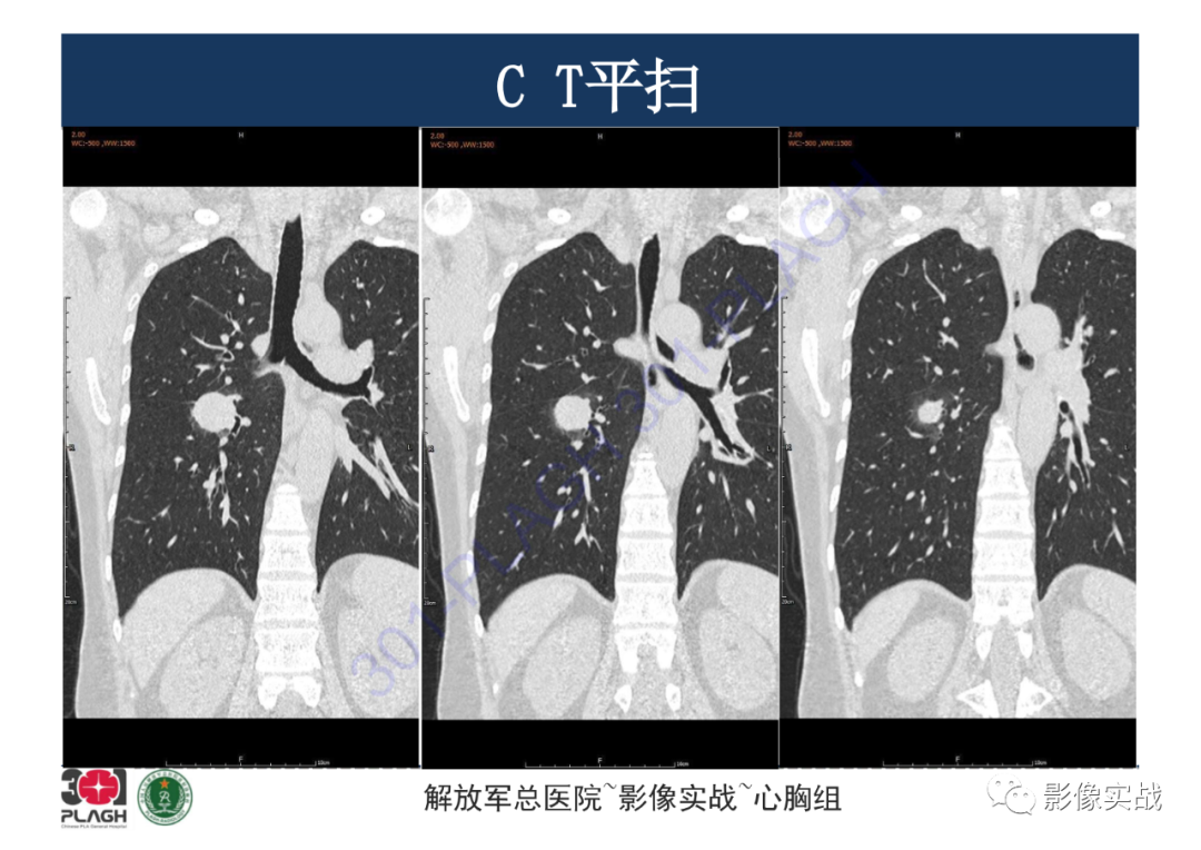影像PPT - 【病例】硬化性肺细胞瘤1例CT影像-12