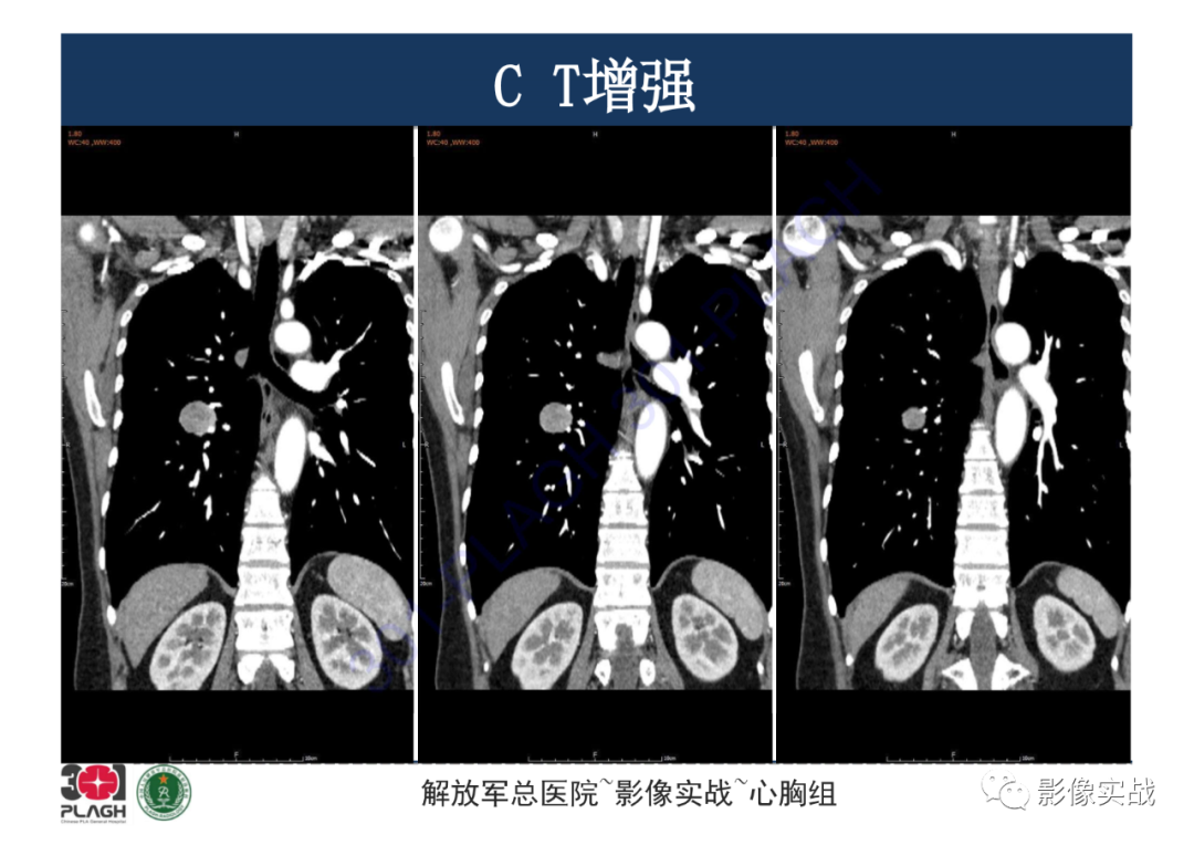 影像PPT - 【病例】硬化性肺细胞瘤1例CT影像-14