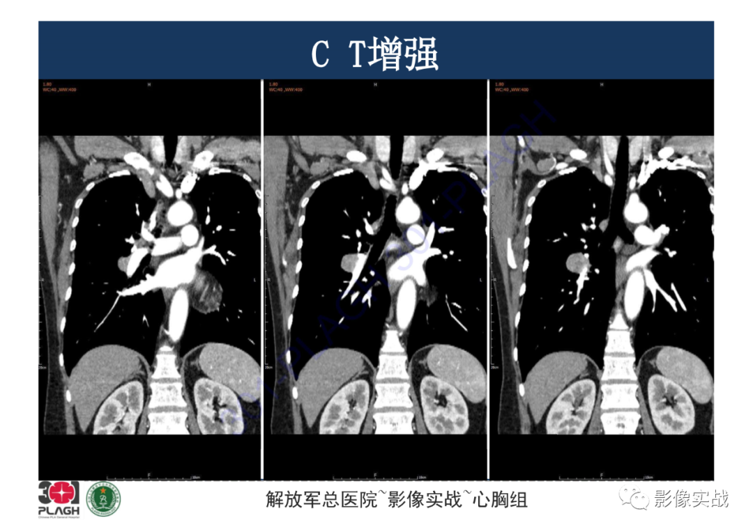 影像PPT - 【病例】硬化性肺细胞瘤1例CT影像-13