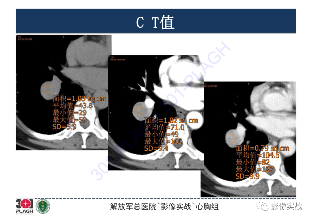 影像PPT - 【病例】硬化性肺细胞瘤1例CT影像-15